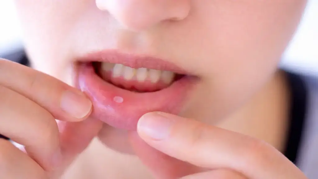 Dấu hiệu cảnh báo ung thư miệng không nên bỏ qua