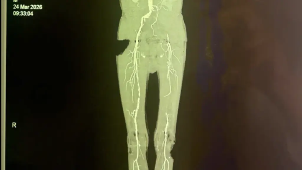 Loét gót chân kéo dài, bệnh nhân suýt phải cưa chân