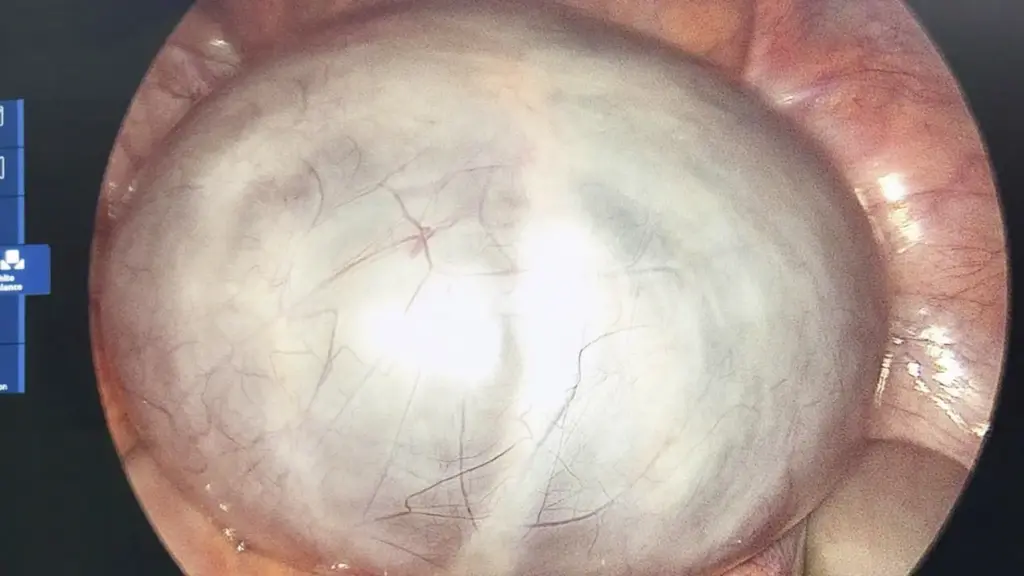 Phẫu thuật lấy khối u buồng trứng nặng khoảng 2kg ở người phụ nữ 33 tuổi