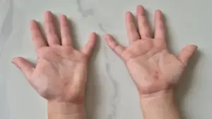 Sai lầm tước đi 'giờ vàng' cứu trẻ tay chân miệng.